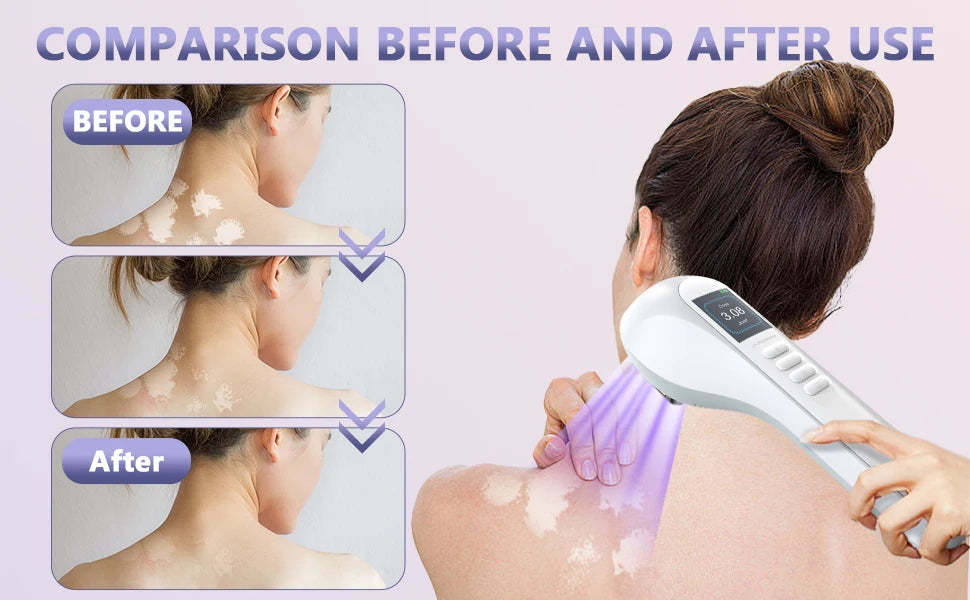 Lampe UVB 308nm pour Vitiligo, Psoriasis, Eczéma – Photothérapie à Domicile