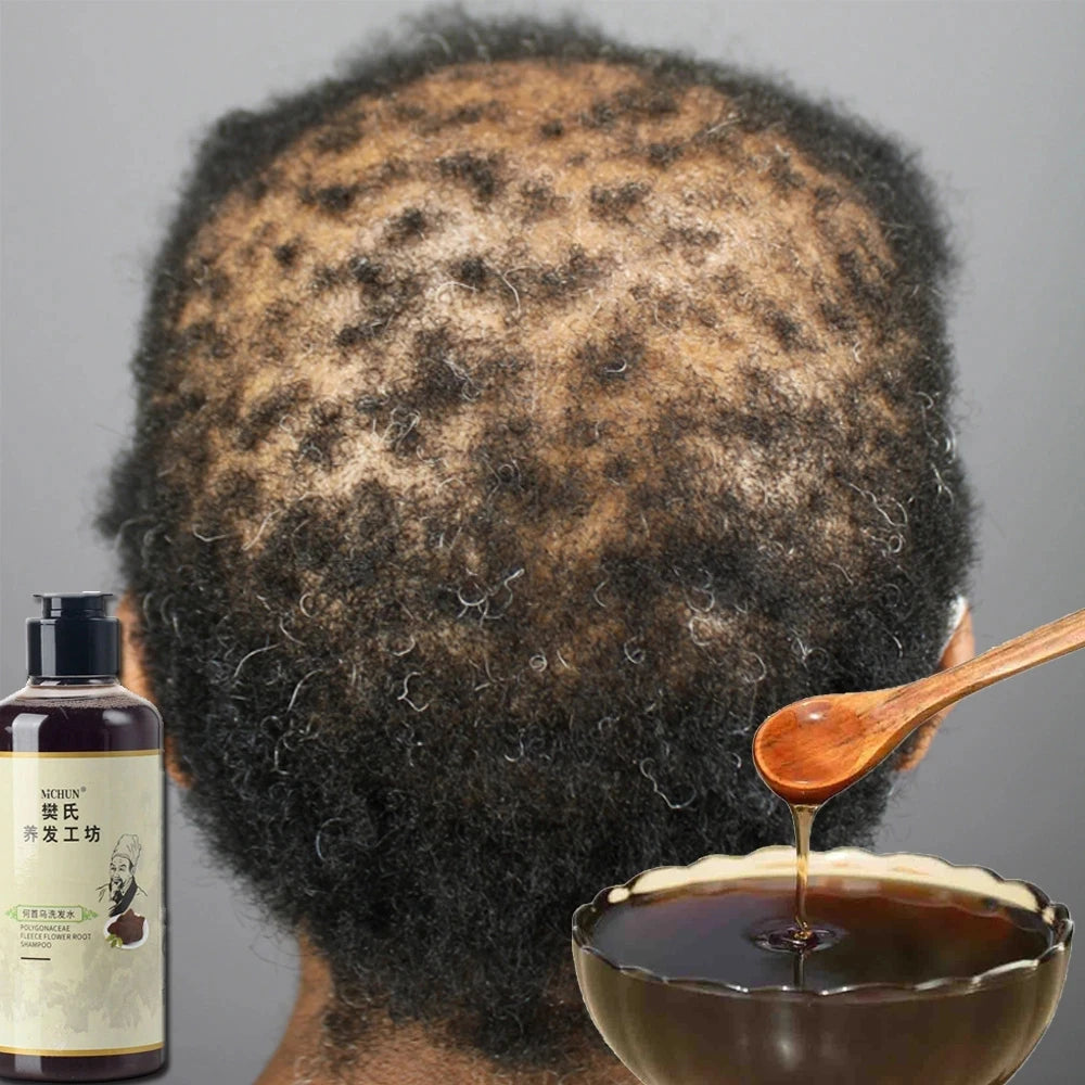 Shampooing Traction Alopécie – 300ml, Traitement Croissance Capillaire pour Femmes & Hommes
